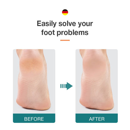 MR.GREEN ft File Double Sided Callus Remover For Dead Skin  Pedic image 2